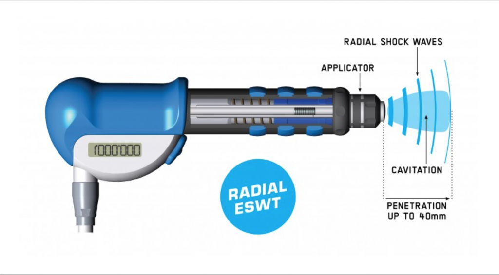 shockwave therapy cochrane